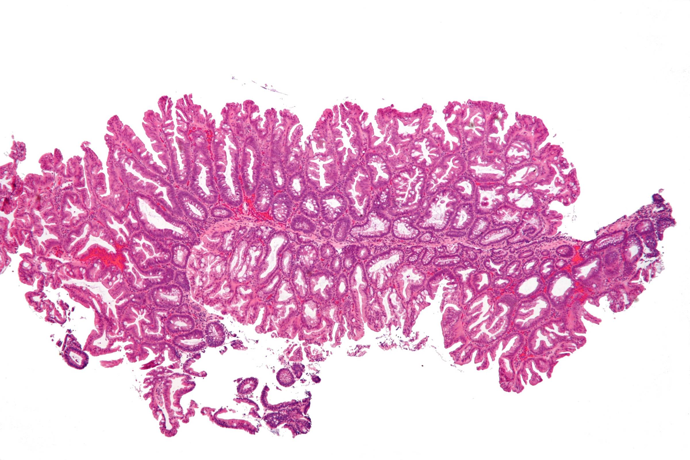 Microscopic cross-section of a sessile serrated polyp, stained dark pink, from Wikimedia Commons