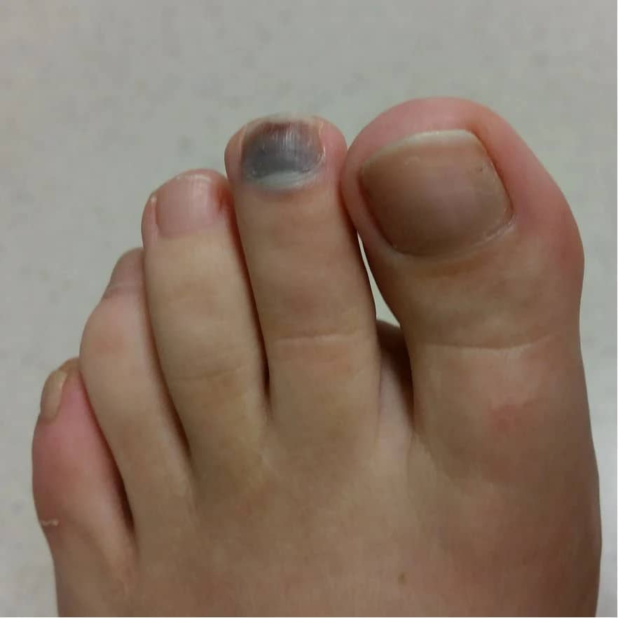 A close-up view of a foot showing a big toe and several smaller toes. The toenail on the second toe has a noticeable bruise or discoloration, appearing dark blue or black. The rest of the toes and nails look normal. The background is a plain, light-colored surface.