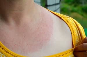 sunburn remedies