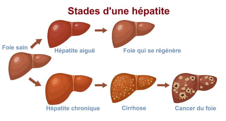 Finit Tout Problème Lié Au Foie