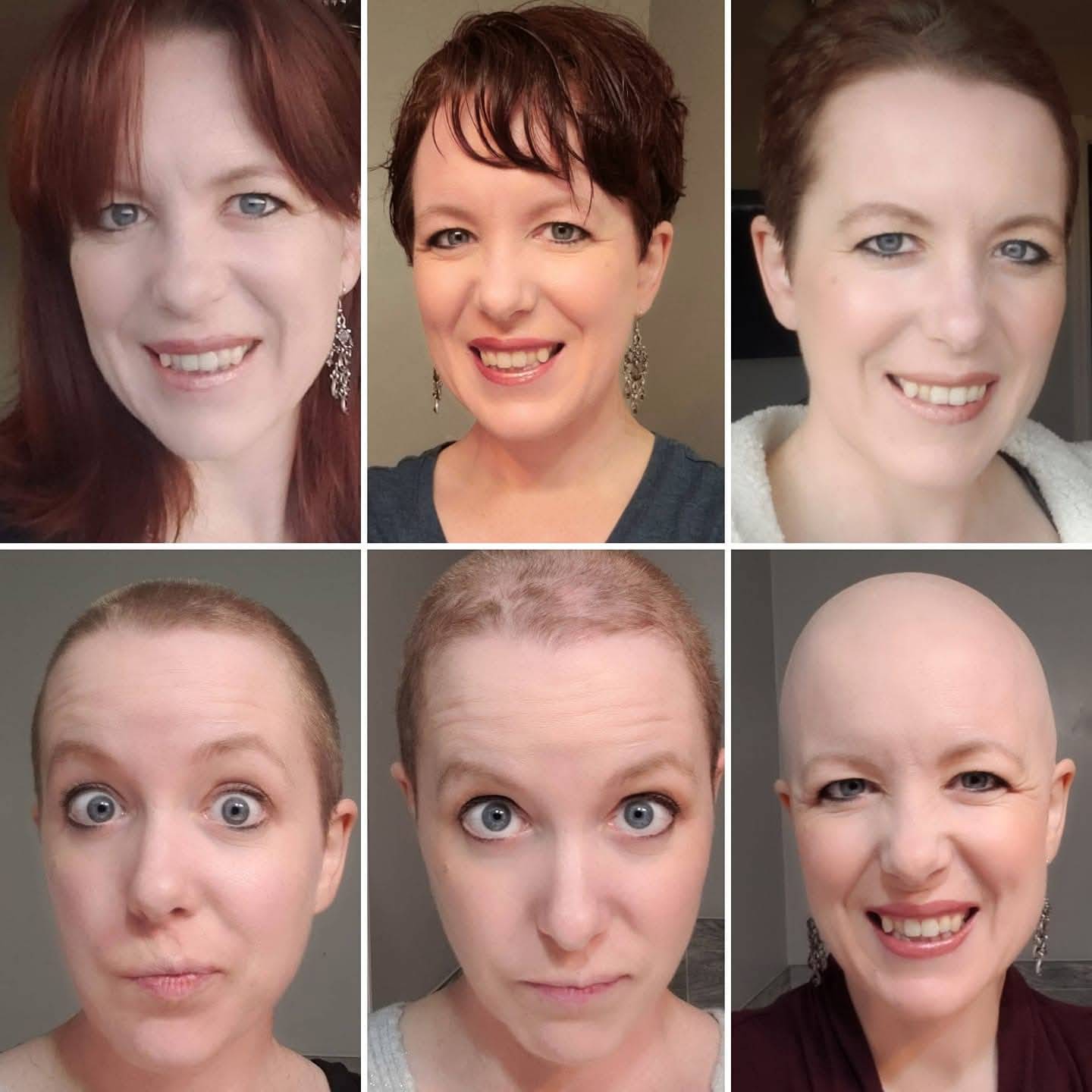 Several photos of the same woman as she progressed through chemo-induced hair loss.
