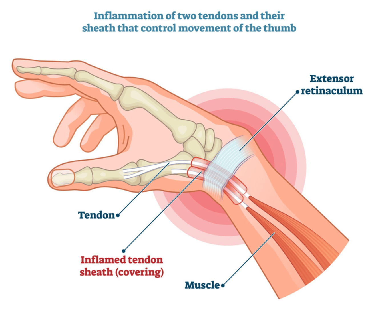 Drawing of the inflamed tendons of DeQuervain's Synovitis