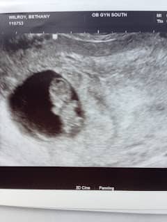 An ultrasound picture of a 12 week old fetus.