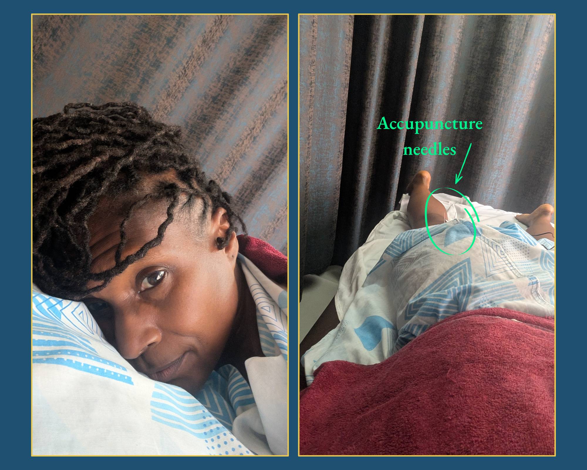 A collage of two photos showing a woman receiving acupuncture on the back of her thigh during a sports massage session. One image shows her lying on a table with needles in her leg; the other shows her resting with her head on a pillow. The images symboli