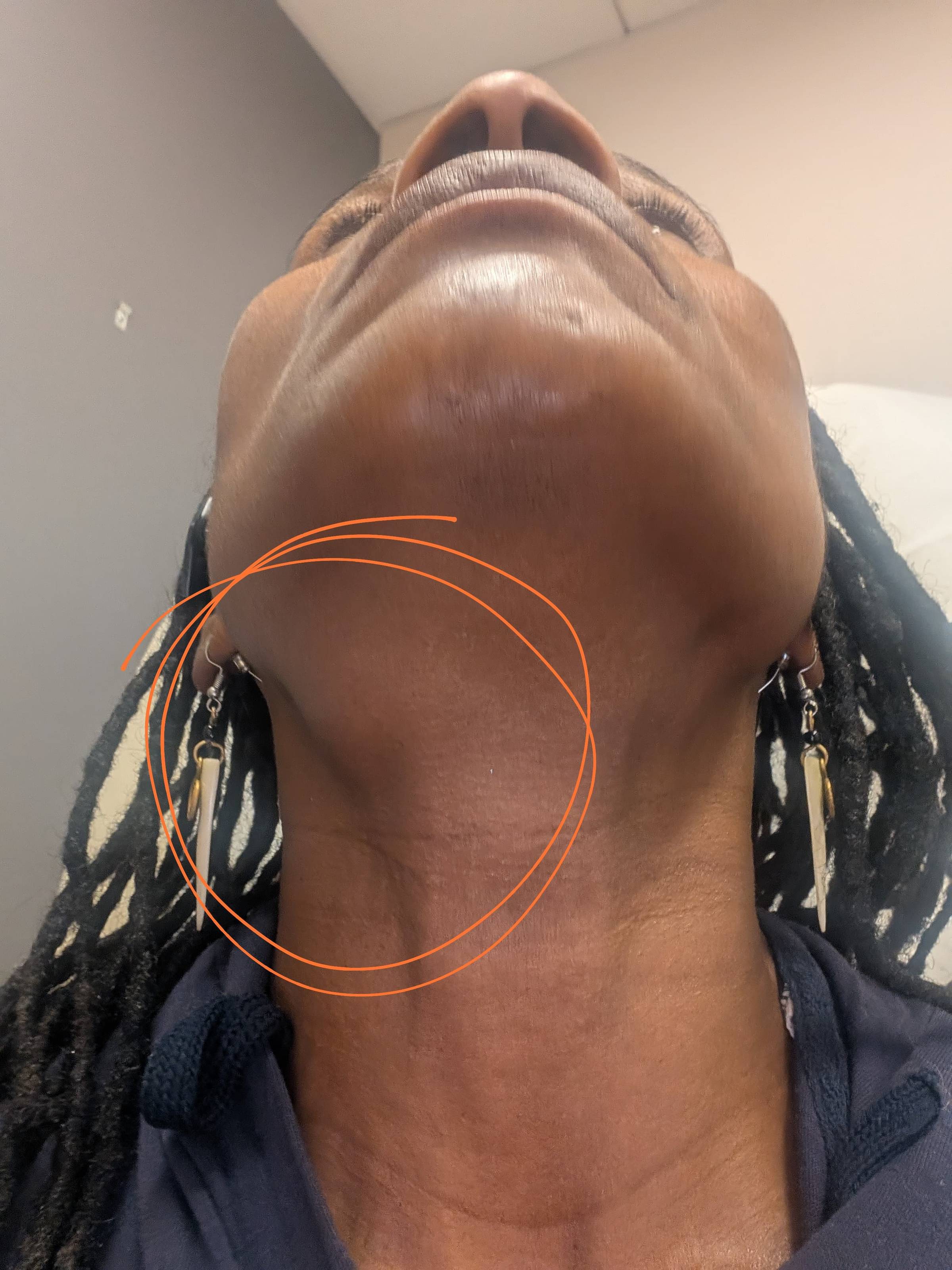 A close‑up photo of Dionne’s throat showing a visible lump on the left side, highlighting sudden swelling and physical expression.