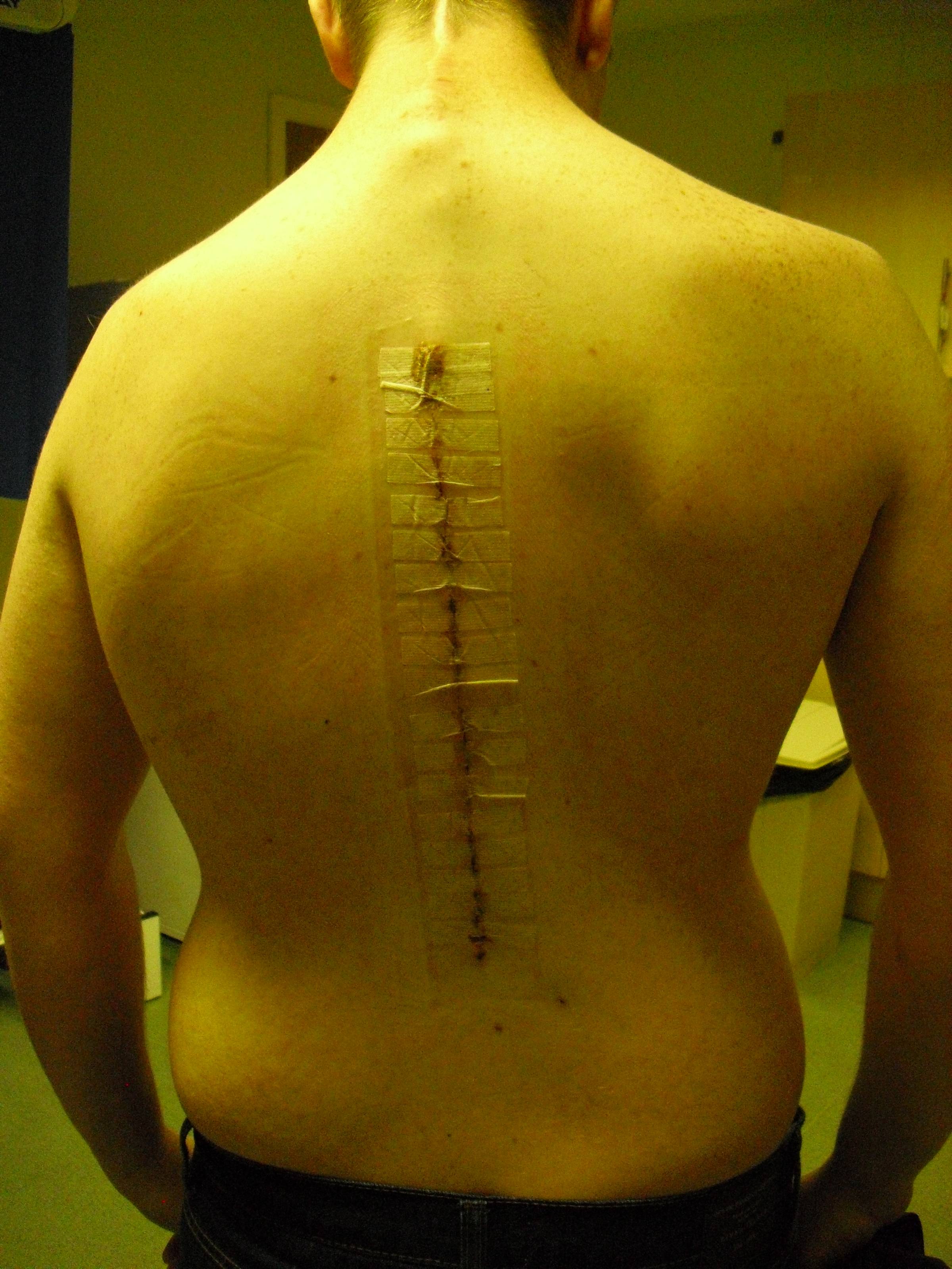 9 Lessons I Learned From a Broken Neck, Neurological Tumour, and a 56 Degree Bend in My Spine