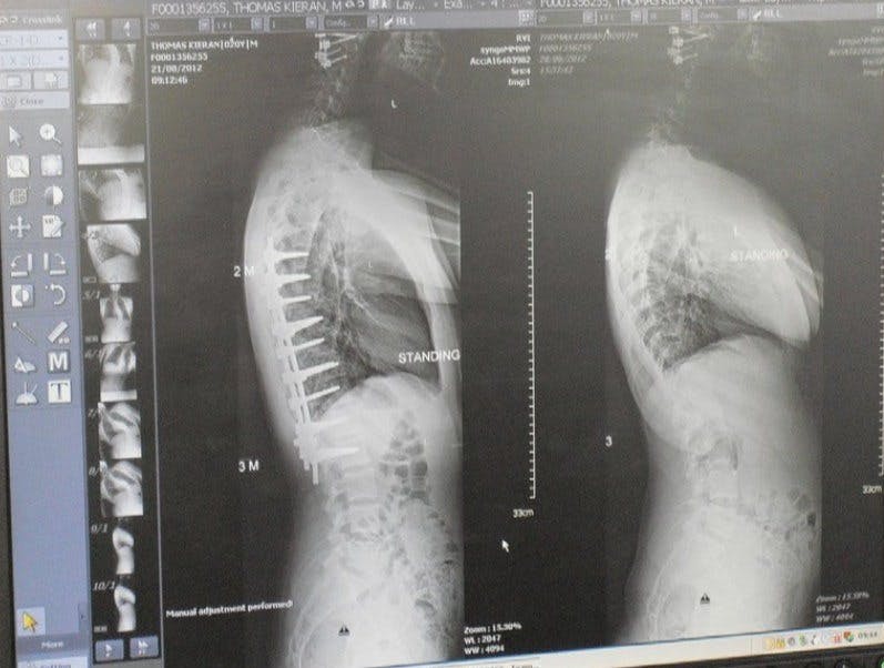 9 Lessons I Learned From a Broken Neck, Neurological Tumour, and a 56 Degree Bend in My Spine