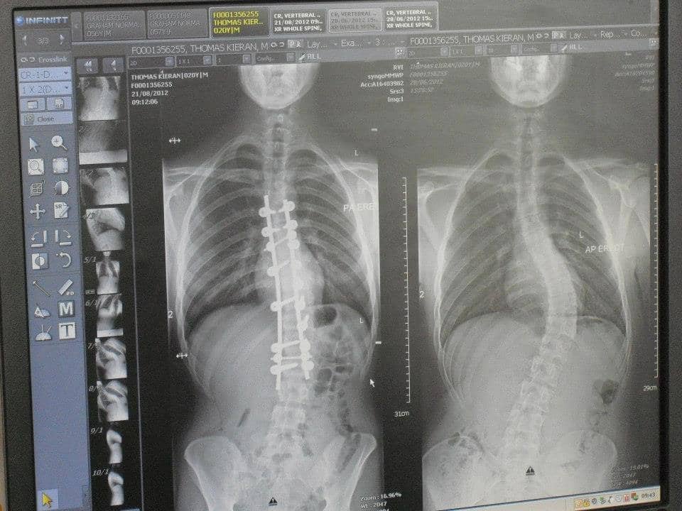 9 Lessons I Learned From a Broken Neck, Neurological Tumour, and a 56 Degree Bend in My Spine