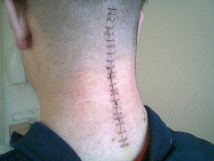9 Lessons I Learned From a Broken Neck, Neurological Tumour, and a 56 Degree Bend in My Spine