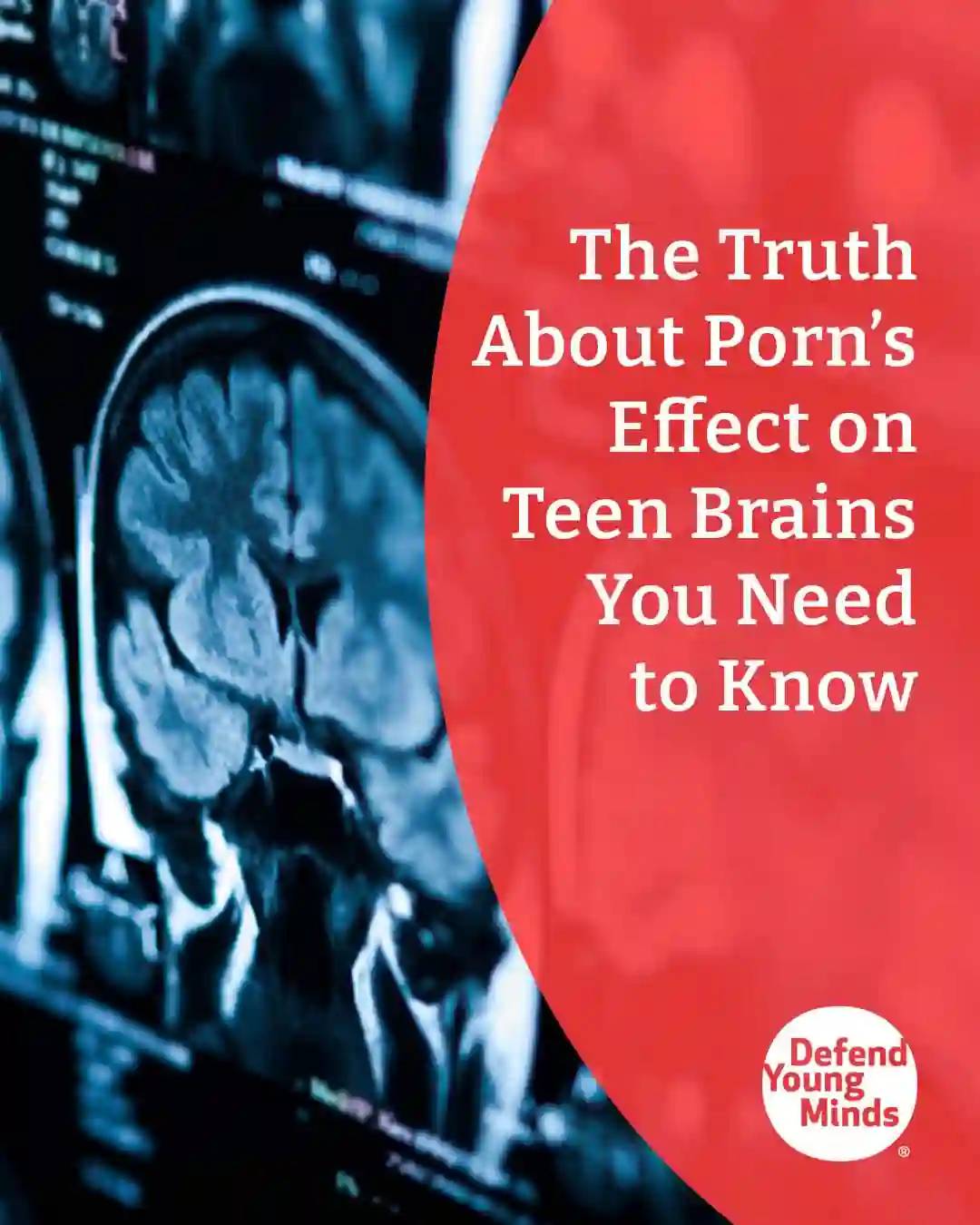 Brain MRI depicting porn's effect on the teen brain