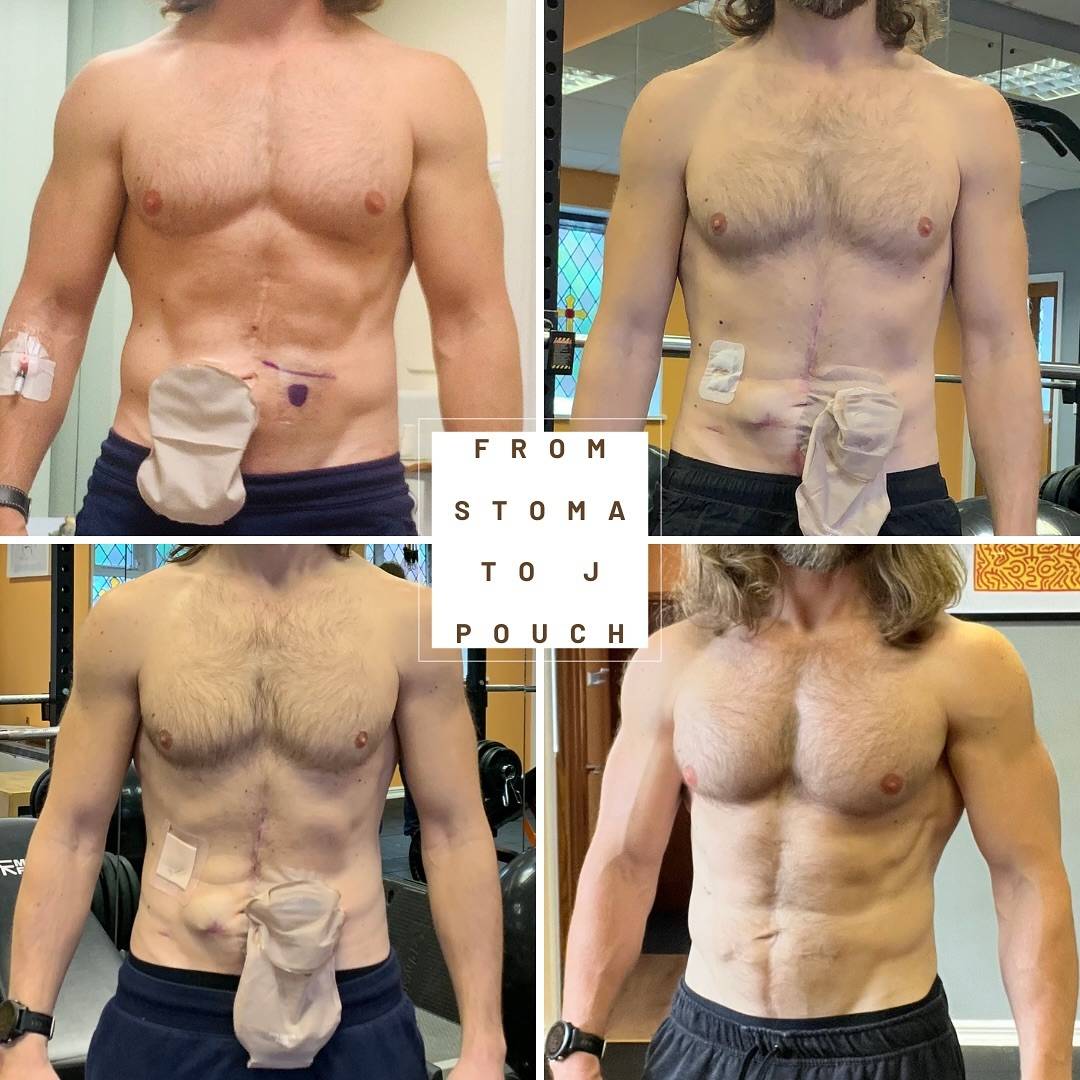 Progression regression, progression regression... Remaining focussed through the tough times will make sure you’ll always finish on progression!

#stomafitness #Jpouchfitness #ileostomy #jpouch #stoma