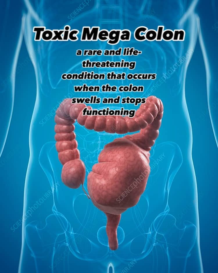 TMC affects a small percentage of UC sufferers, and requires life saving surgery to remove the colon. By this point my colon was perforated and poisoning my body as I was slowly submitting to this disease. It had swollen to huge proportions, but was as thin as tissue paper. Fortunately my life was saved and I am healthier than I have been in years. #toxicmegacolon #jpouch #ulcerativecolitisfighter #stoma