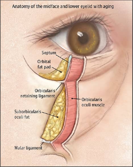 Diagram showing pseudoherniation of suborbicularis oculi fibroadipose tissue (fat pads bulging forward).