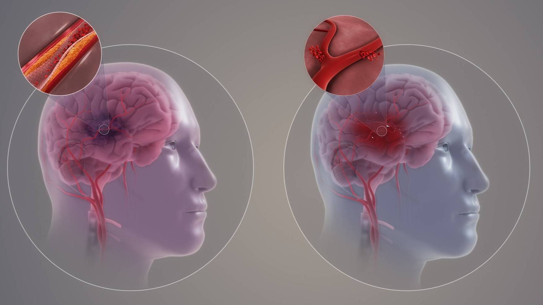 Left: An ischemic stroke is caused by a blocked blood vessel. Right: A hemorrhagic stroke is caused by a burst blood vessel.