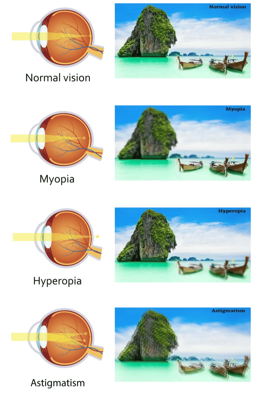 Diagram showing different refractive errors with the eye anatomy and the actual POV from the person with the error 