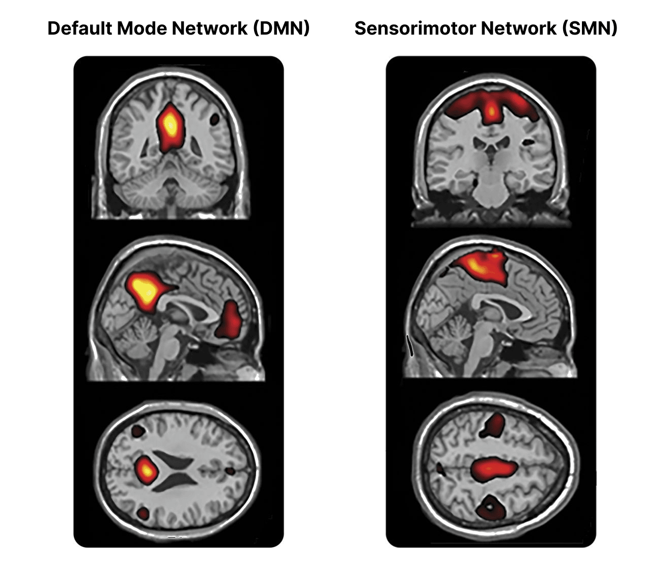 MRI scans of the default mode network and the sensorimotor network. 
