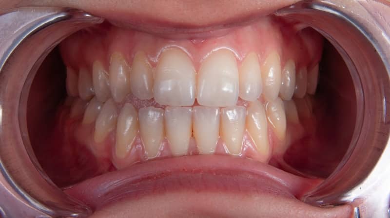 a person's mouth with teeth