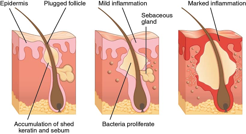 Diagram showing the stages of acne formation. 