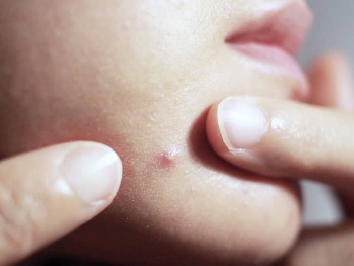 pimple