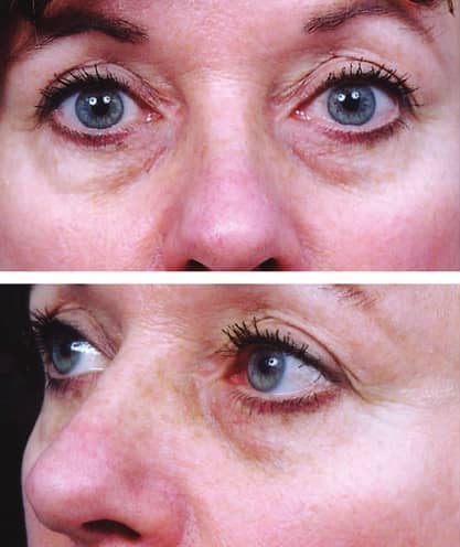 A person with pronounced tear troughs
