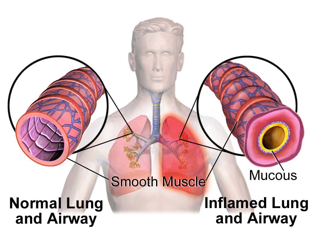 A diagram showing a normal breathing tube (left) vs. one experiencing a bronchospasm (right).
