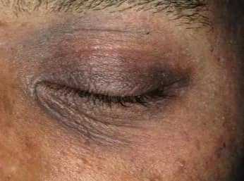 person with thickened skin around their eye