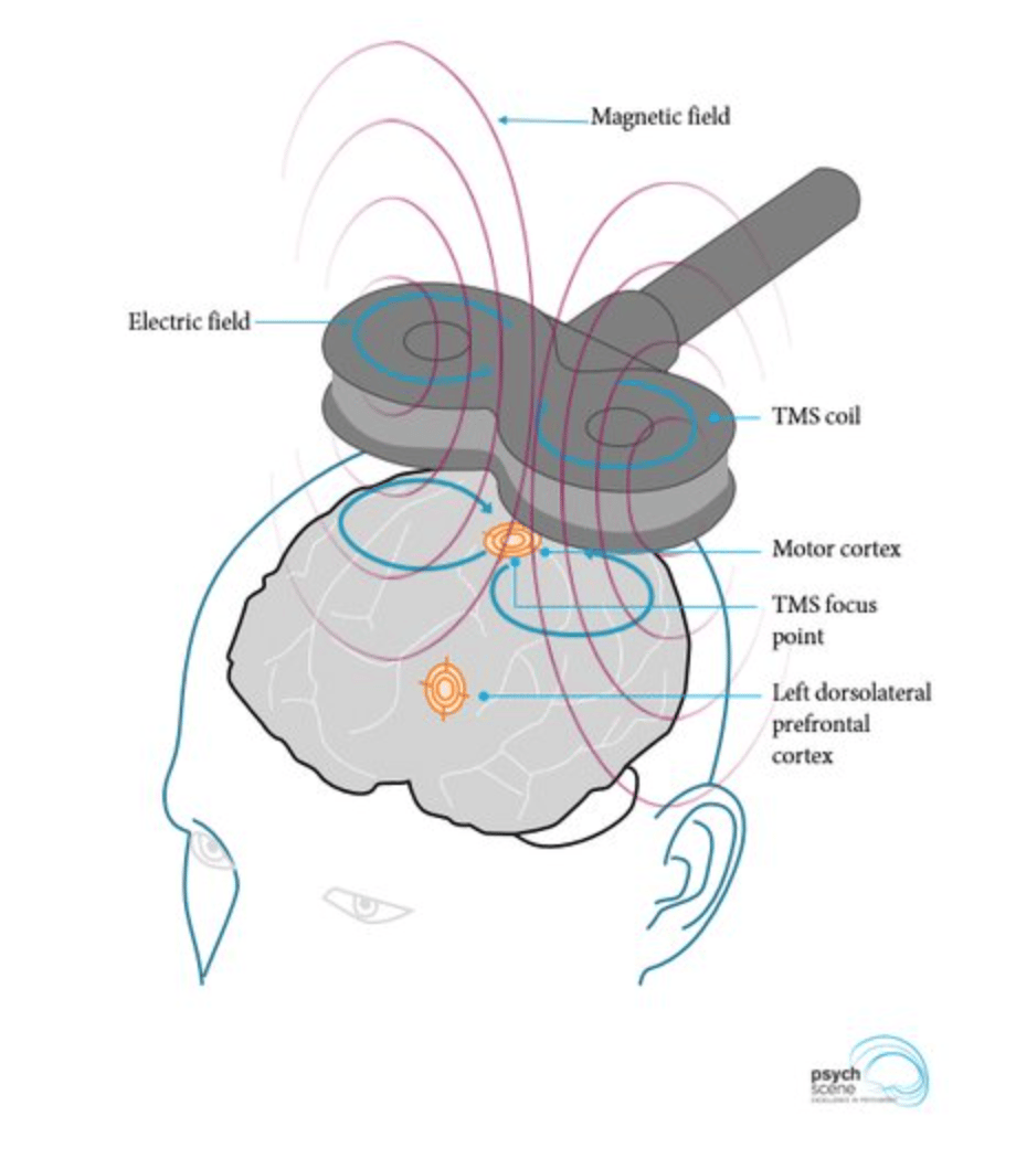 Diagram showing transcranial magnetic stimulation 