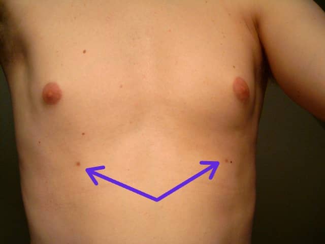 image showing a man with a pair of supernumerary nipples, noted with purple arrows