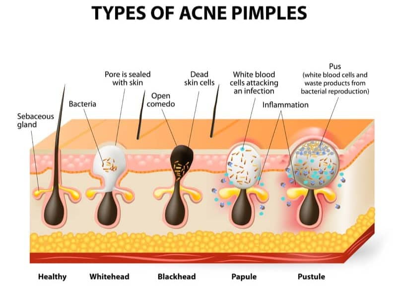 Diagram showing five types of acne. 