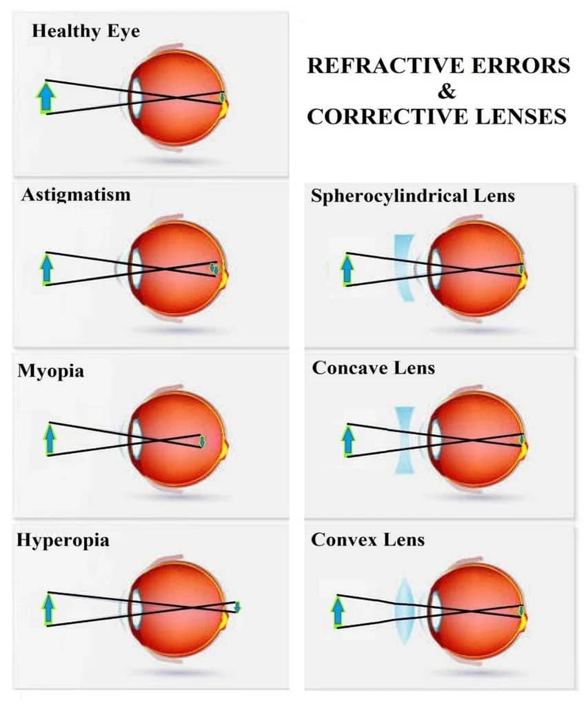 Diagram showing refractive errors and how different corrective lenses fix the errors. 