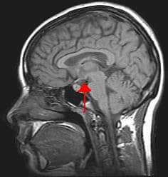 Location of the hypothalamus on a brain scan 