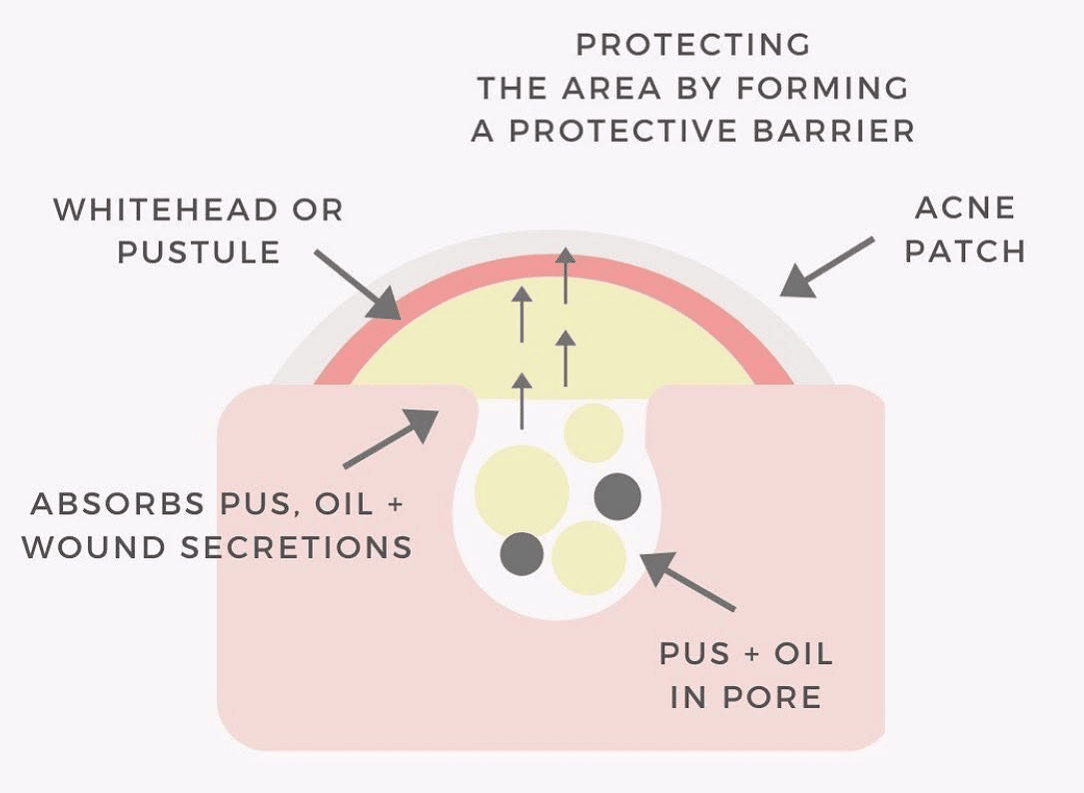 Diagram showing how pimple patches work to absorb oil. 