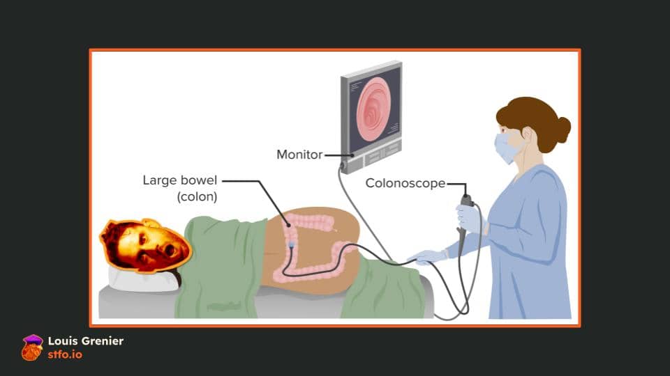 Colonoscopy