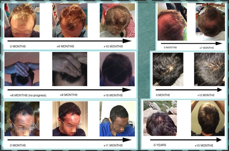 Genes & Hair Loss Not So Simple Anymore Perfect Hair Health