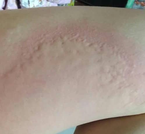 Urticaria