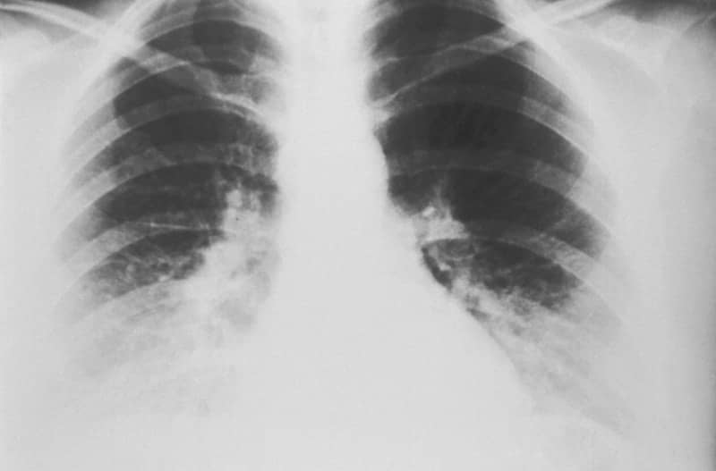 Frontal chest x-ray displaying lungs and heart