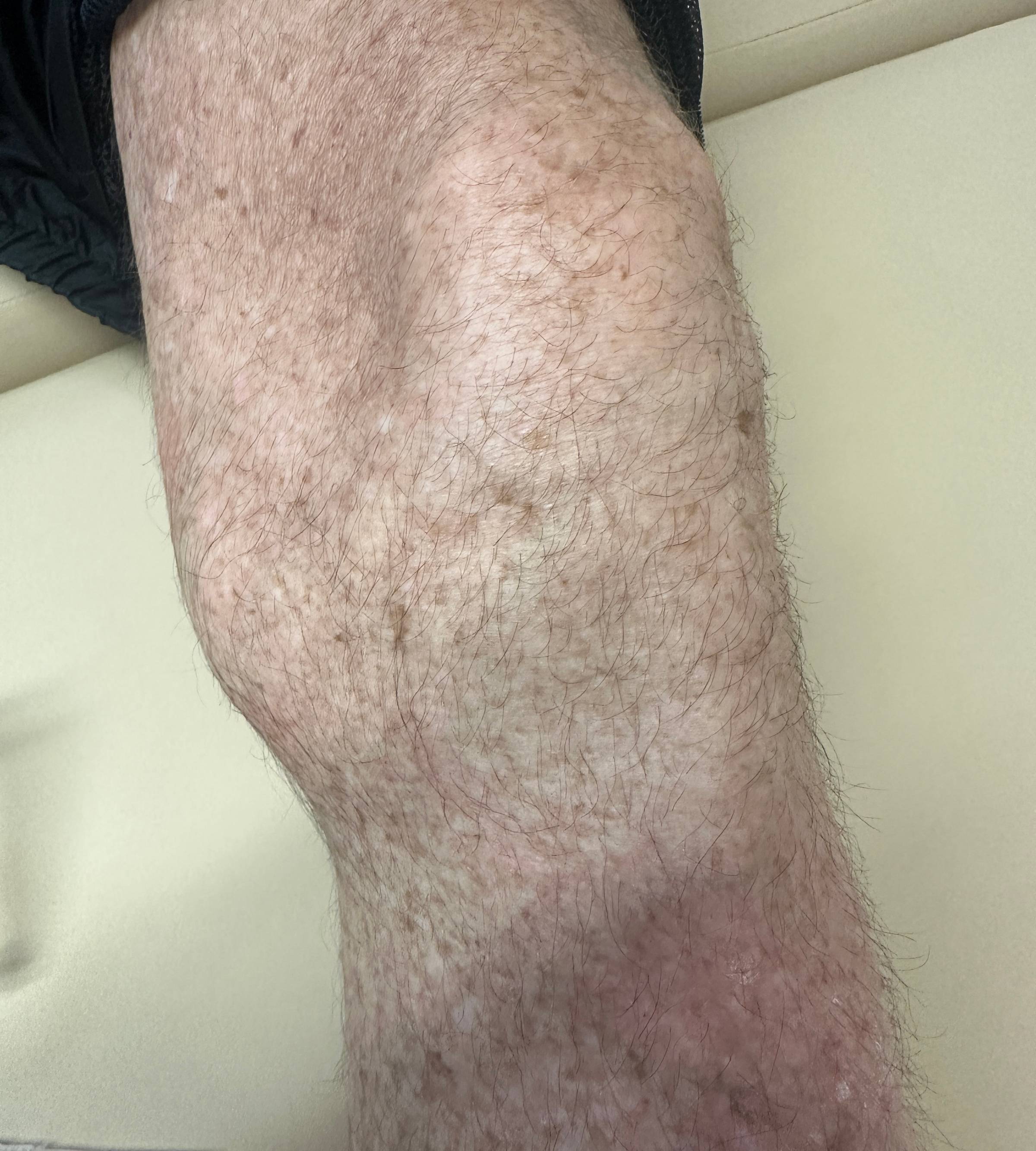 Posteromedial knee prominence before aspiration