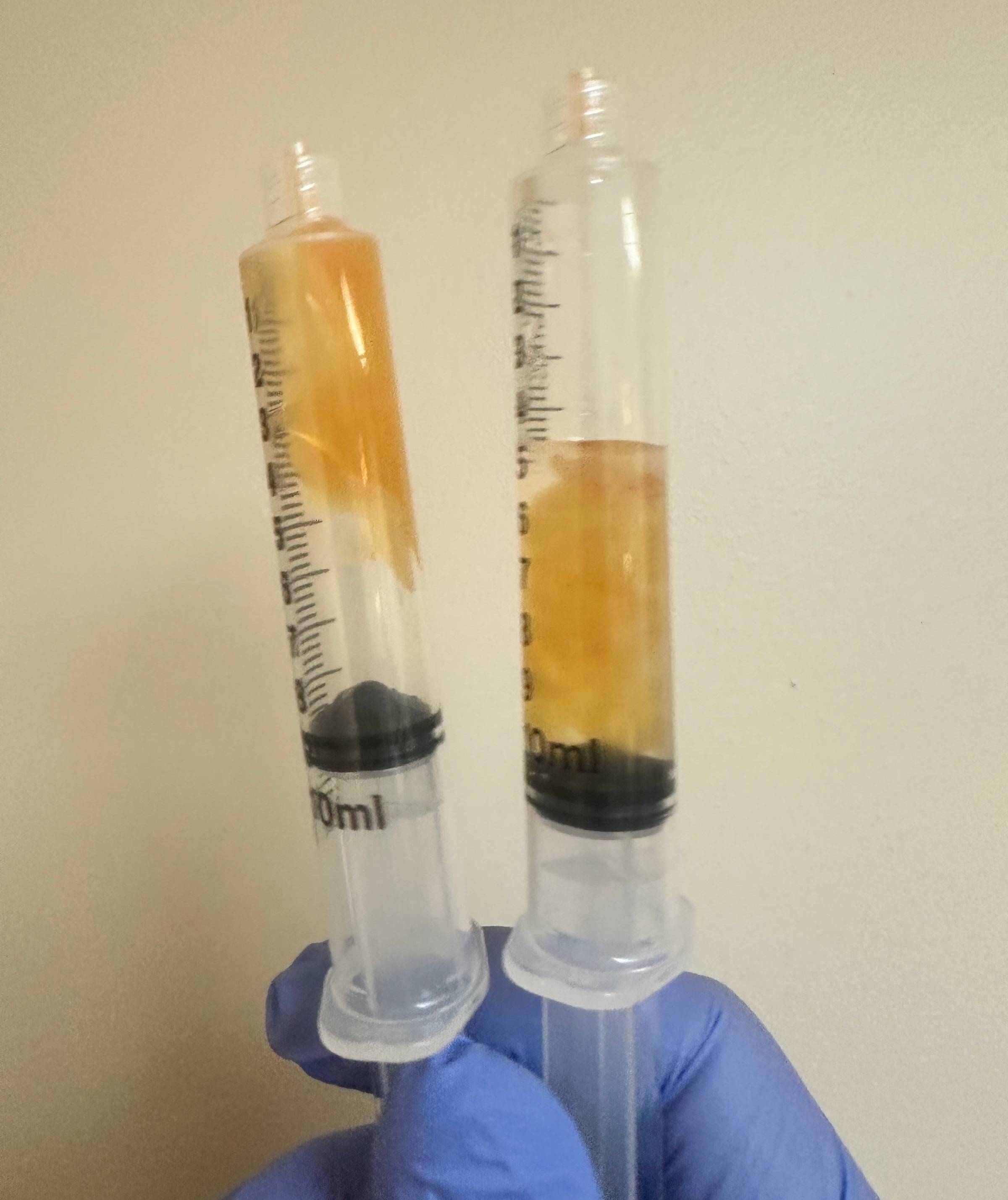 Initial viscous aspirate alongside aspirate obtained after lidocaine dilution