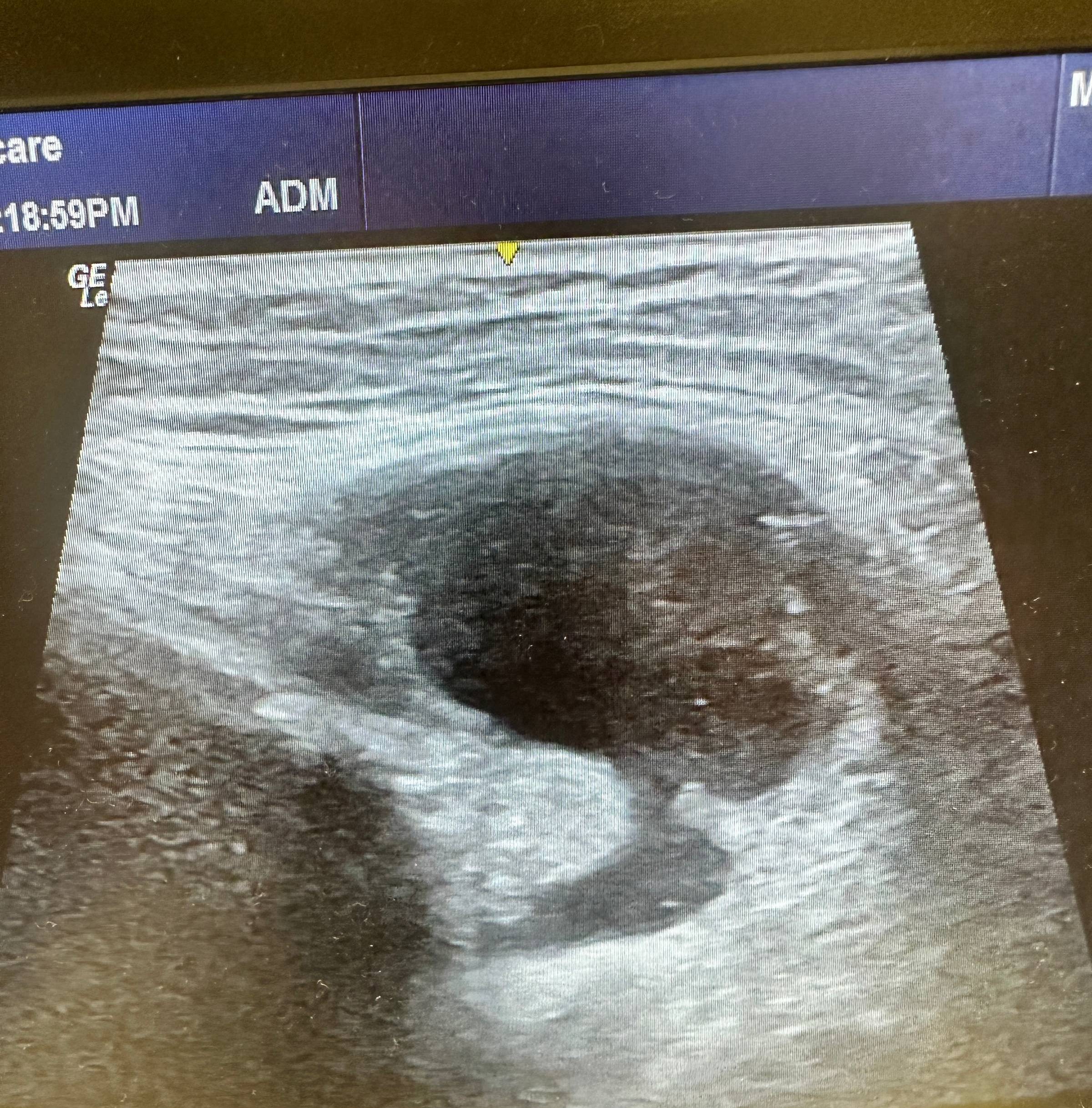 Ultrasound image of the knee cyst