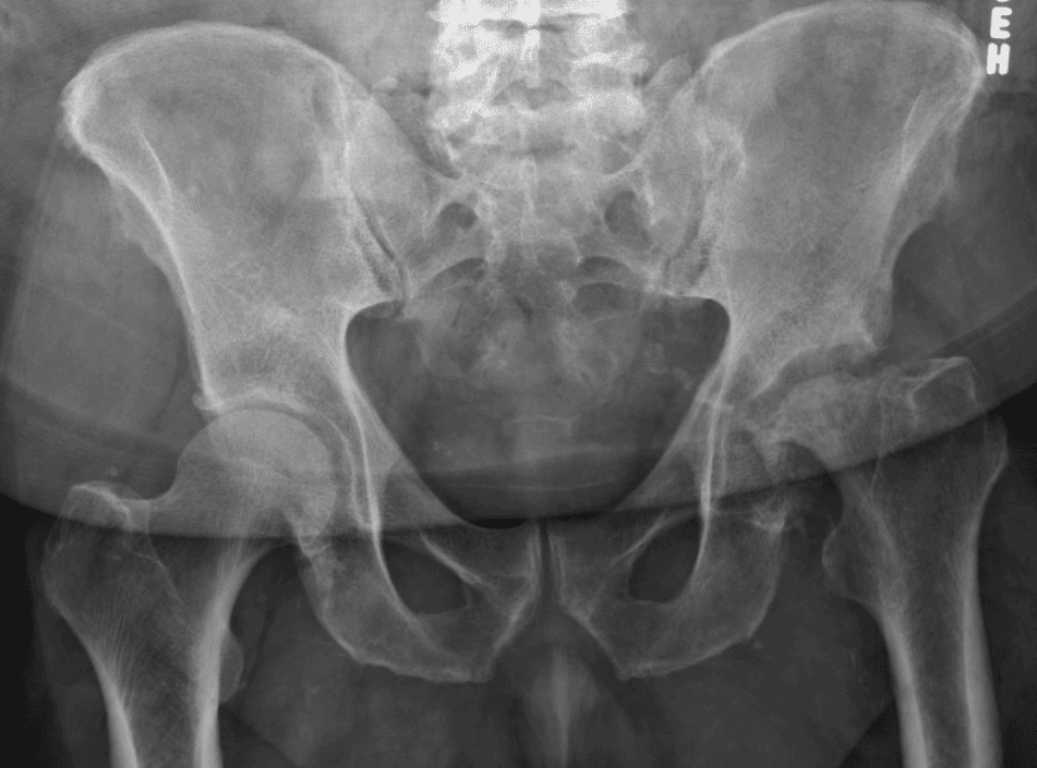AP pelvis radiograph, April 2017