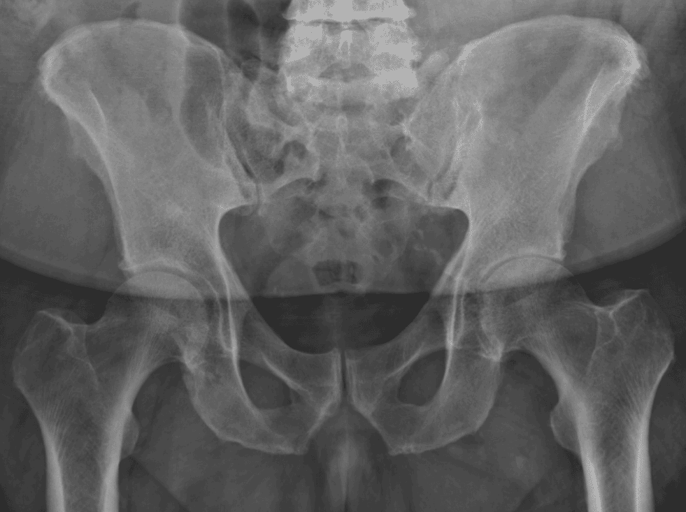 AP pelvis radiograph, December 2016