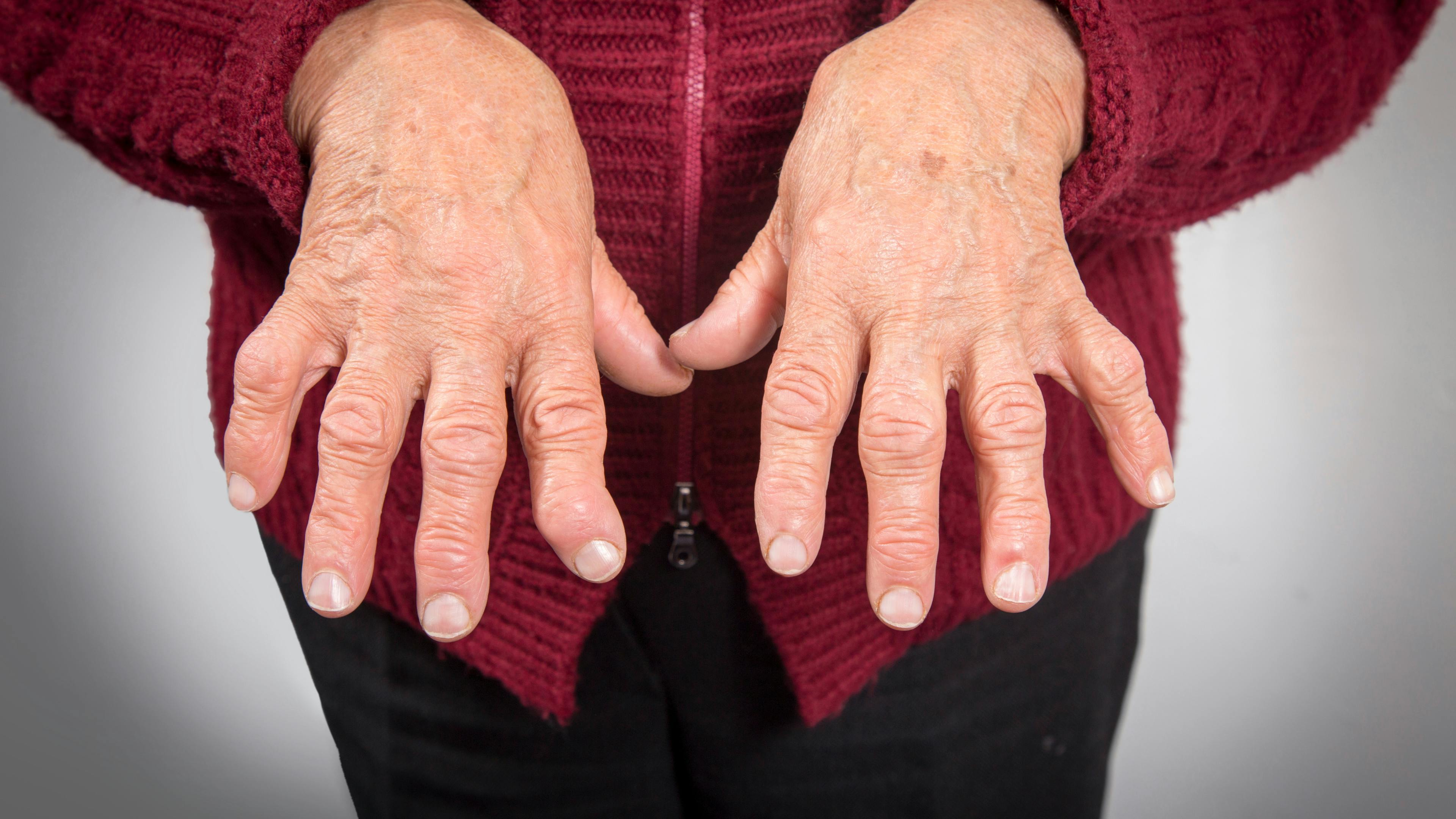 Rheumatoid Arthritis Hands