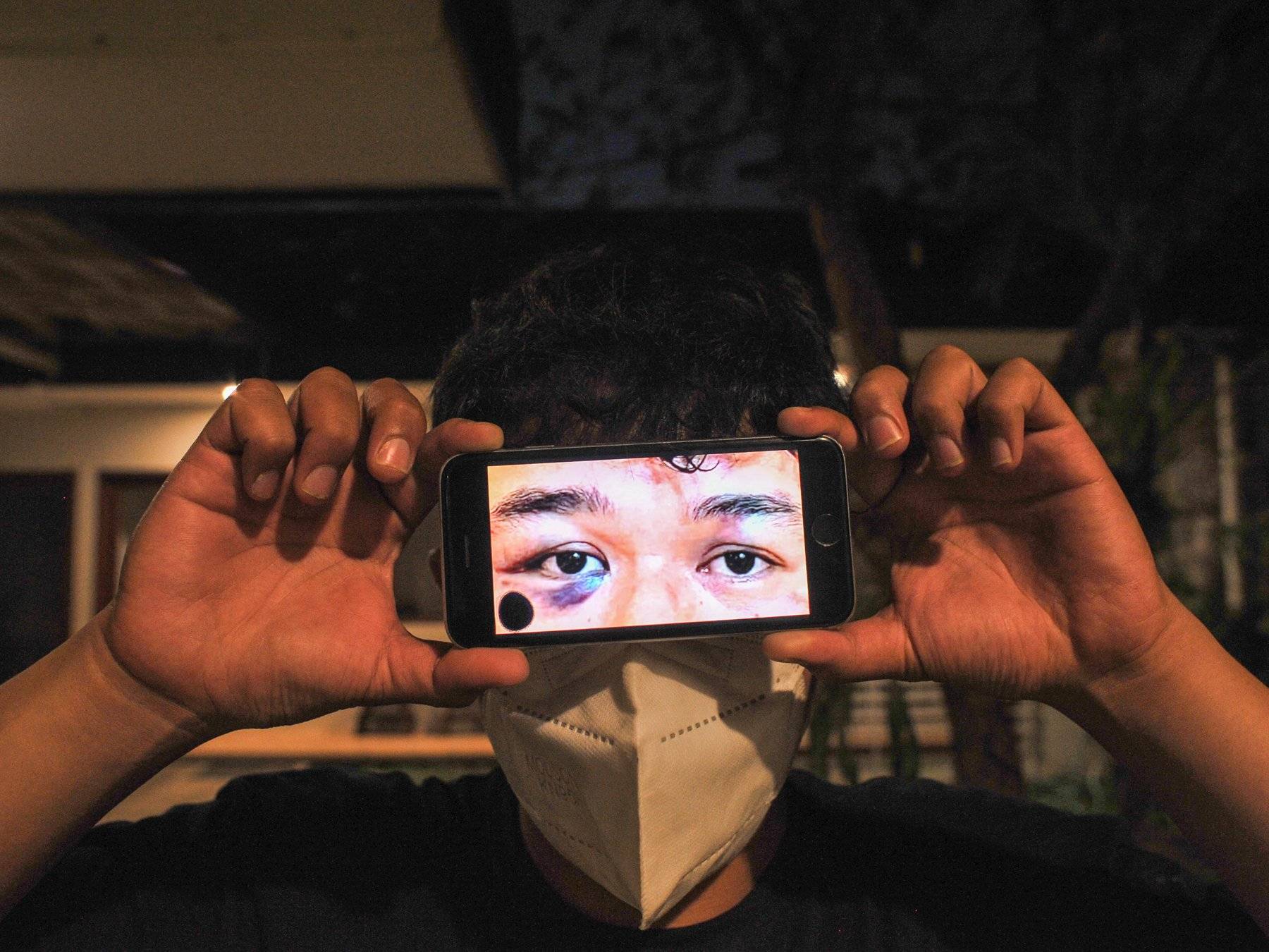 Guntur (27) menunjukkan foto luka akibat kekerasan polisi saat mengikuti aksi penolakan RUU Pilkada pada 22 Agustus 2024. (Project M/Bukbis Candra Ismet Bey)