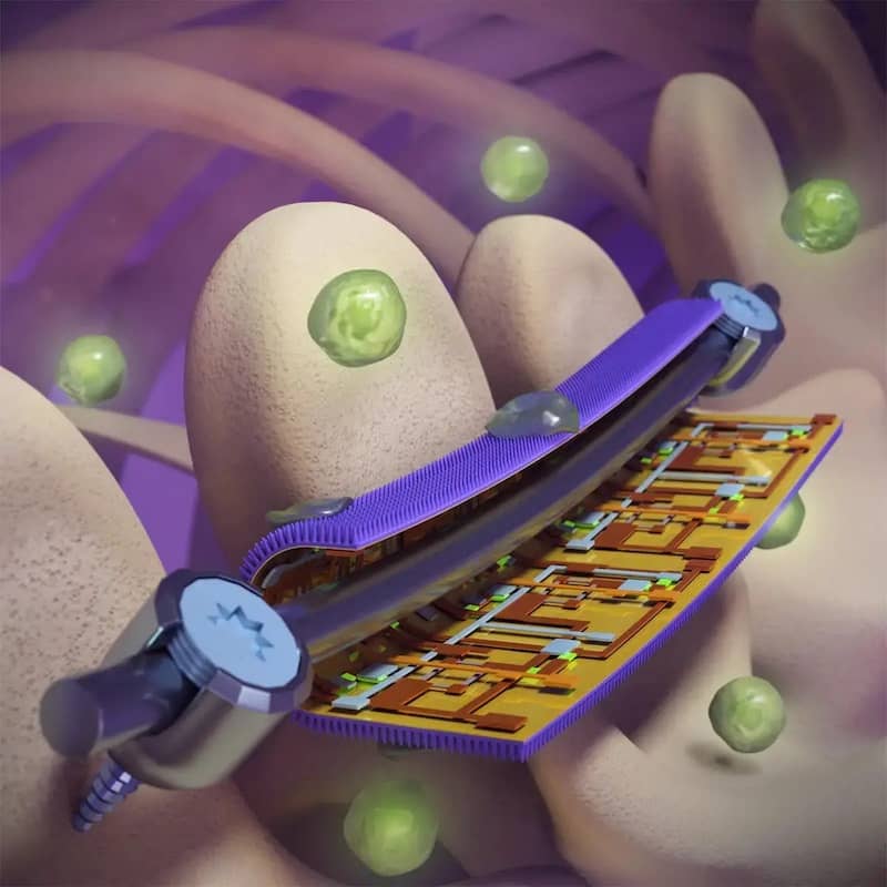 Smart Implant