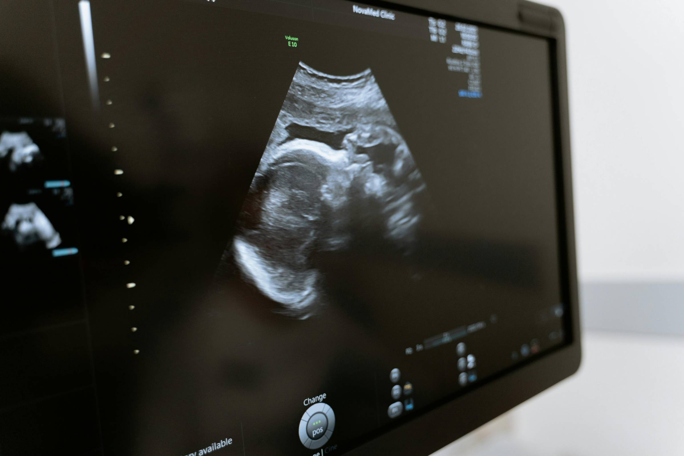 Ultrasound of a fetus on a screen