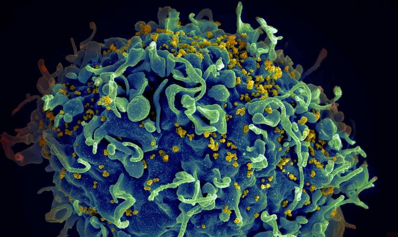 An electron microscope image shows a human T cell, blue, under attack by HIV, yellow, the virus that causes AIDS.