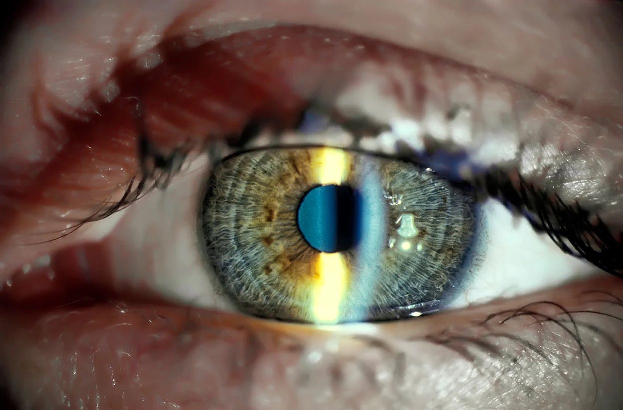 Close-up photo of a person's eye with a light shining in it