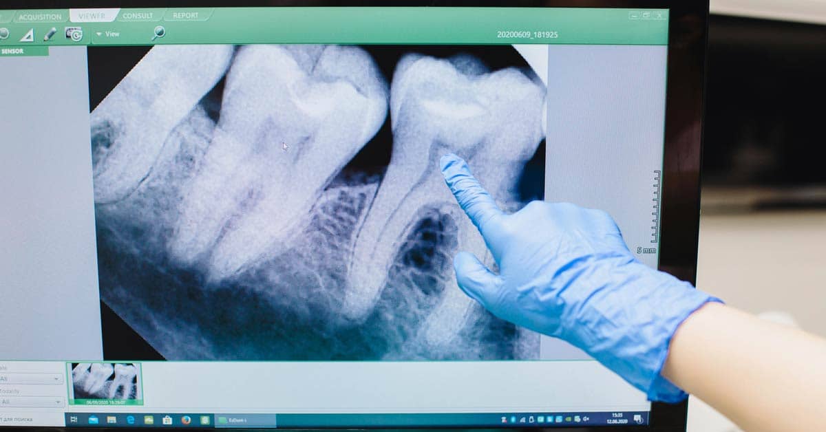 An x-ray of three molars on a computer screen, a person wearing a blue latex glove is pointing at one of the teeth