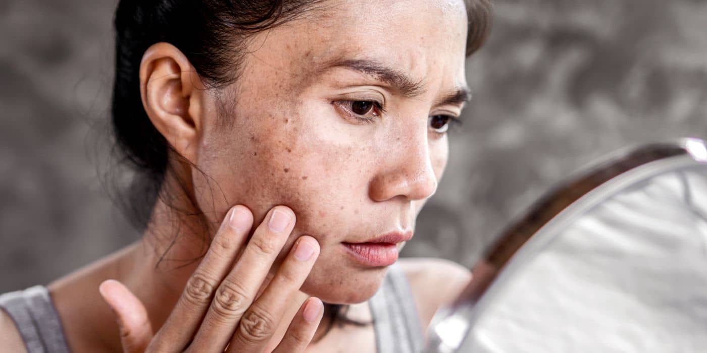 Close-up of uneven skin tone and dark spots on the cheek